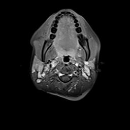 File:Bilateral carotid body tumors and right jugular paraganglioma (Radiopaedia 20024-20060 Axial 99).jpg