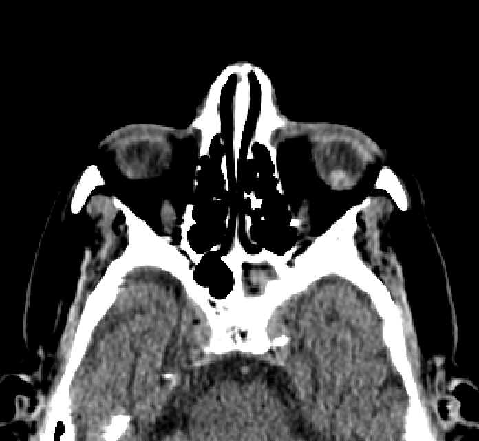 Bilateral ectopia lentis (Radiopaedia 89889-107013 Axial non-contrast 59).jpg