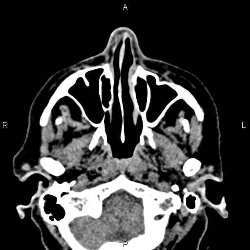 File:Bilateral enlargement of lacrimal glands - sarcoidosis (Radiopaedia 62627-70921 Axial non-contrast 10).jpg