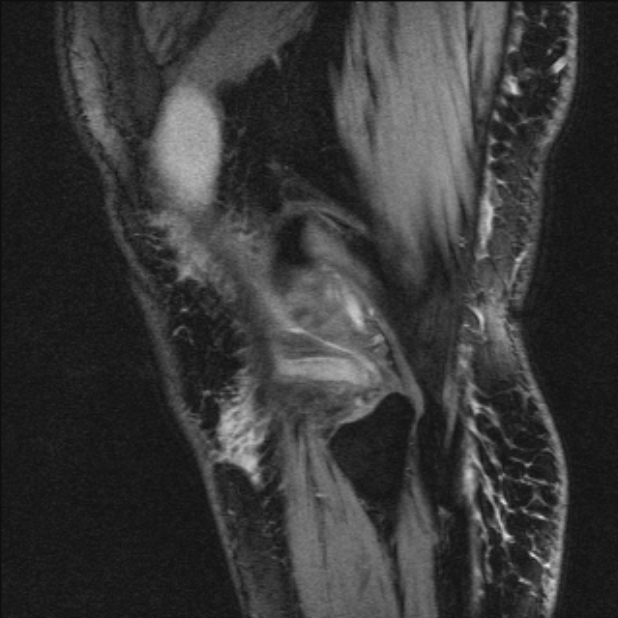 Bilateral focal pigmented villonodular synovitis (Radiopaedia 67643-77073 Sagittal T1 vibe 10).jpg