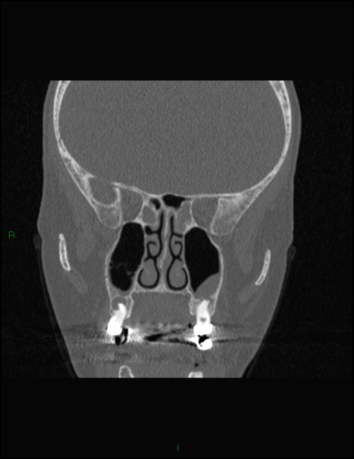 Bilateral frontal mucoceles (Radiopaedia 82352-96454 Coronal 172).jpg