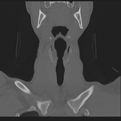 Bilateral locked facets (Radiopaedia 33850-35016 Coronal bone window 21).png