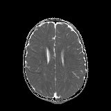File:Bilateral mesial temporal polymicrogyria (Radiopaedia 76456-88181 Axial ADC 17).jpg