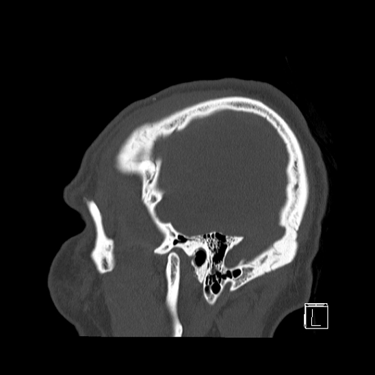 Bilateral occipital condyle fracture (type 2) (Radiopaedia 87675-104089 Sagittal bone window 104).jpg