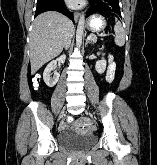 Bilateral ovarian dermoid cysts (Radiopaedia 85785-101603 C 33).jpg