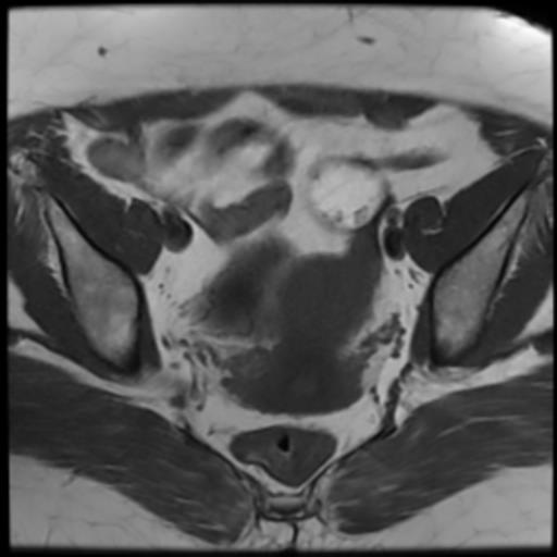 File:Bilateral ovarian dermoid cysts (Radiopaedia 90152-107338 Axial T1 12).jpg