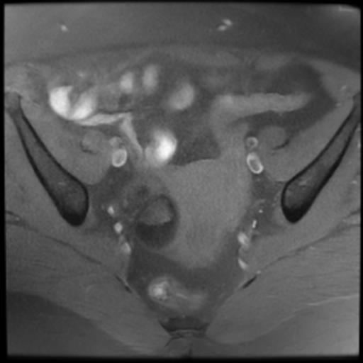 File:Bilateral ovarian dermoid cysts (Radiopaedia 90152-107338 Axial T1 fat sat 10).jpg