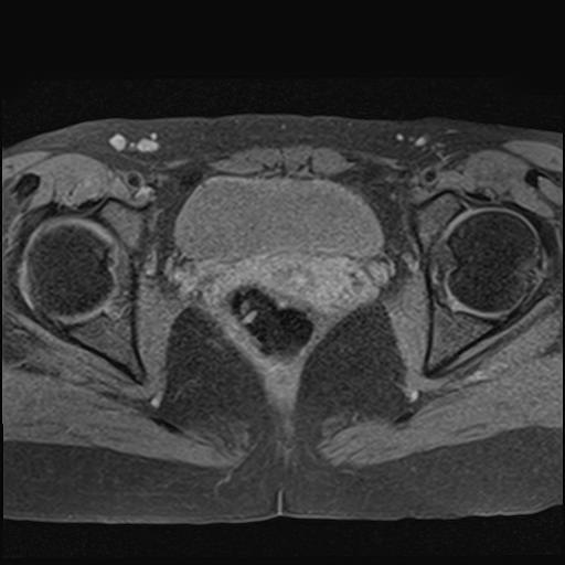 File:Bilateral ovarian endometriomas (Radiopaedia 87085-103347 Axial T1 fat sat 16).jpg