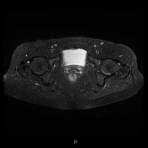 File:Bilateral ovarian fibroma (Radiopaedia 44568-48293 Axial STIR 23).jpg