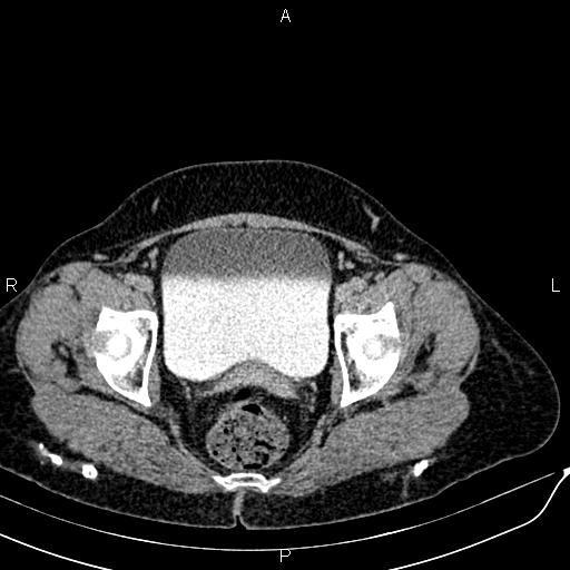 Bilateral ovarian serous cystadenocarcinoma (Radiopaedia 86062-101989 Axial C+ delayed 74).jpg