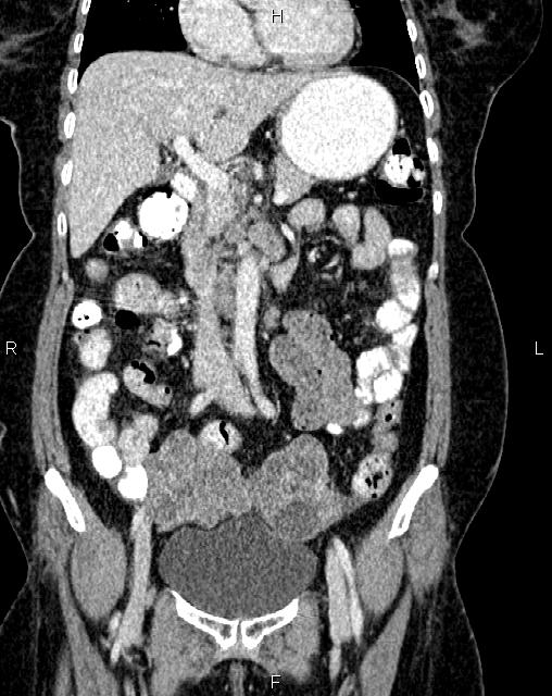 Bilateral ovarian serous cystadenocarcinoma (Radiopaedia 86062-101989 D 16).jpg