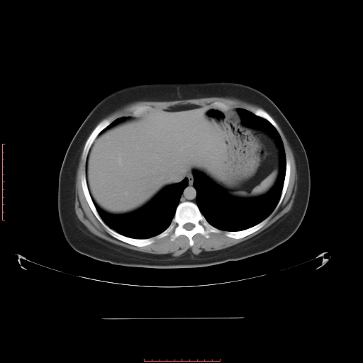 File:Bilateral ovarian serous cystadenocarcinoma with right ovarian torsion (Radiopaedia 32640-33611 A 6).jpg