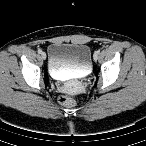 Bilateral ovarian teratoma (Radiopaedia 83131-97503 B 56).jpg