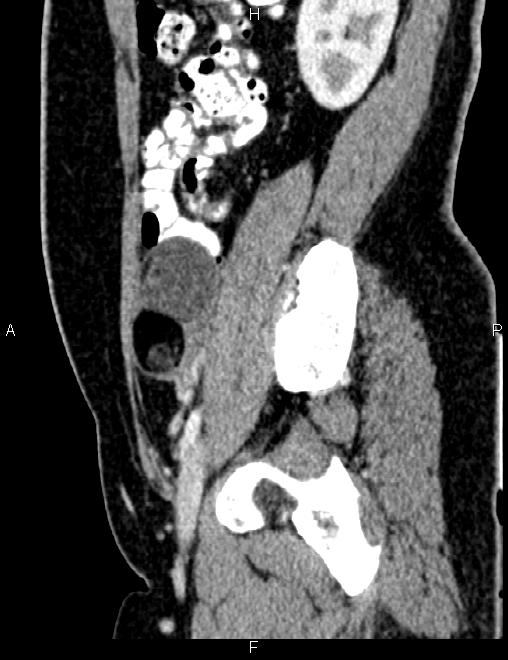 Bilateral ovarian teratoma (Radiopaedia 83131-97503 D 43).jpg