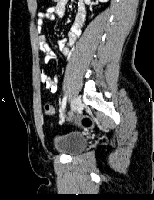Bilateral ovarian teratoma (Radiopaedia 83131-97503 D 74).jpg