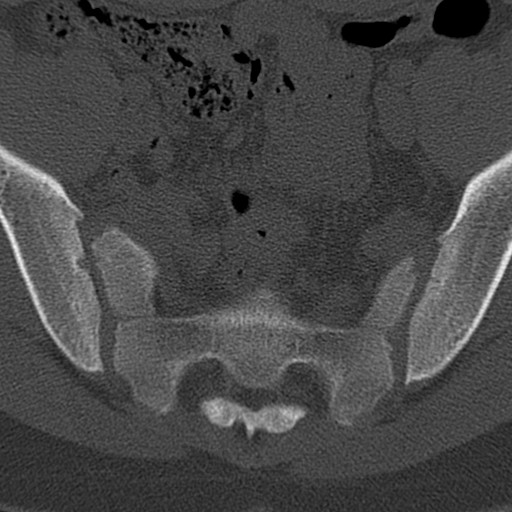 Bilateral pars defect (Radiopaedia 26691-26846 Axial bone window 103).jpg