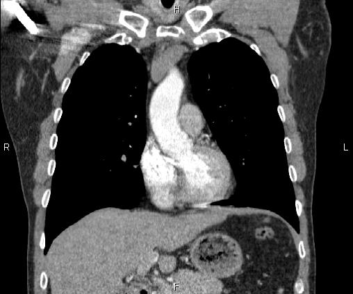 Bilateral pulmonary AVM (Radiopaedia 83134-97505 C 30).jpg