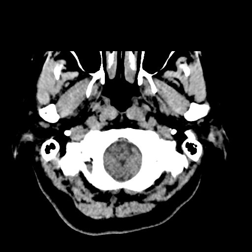Bilateral subacute subdural hematoma (Radiopaedia 69240-79018 Axial non-contrast 4).jpg