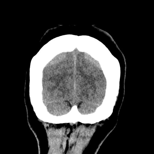 File:Bilateral subacute subdural hematoma (Radiopaedia 69240-79018 Coronal non-contrast 52).jpg