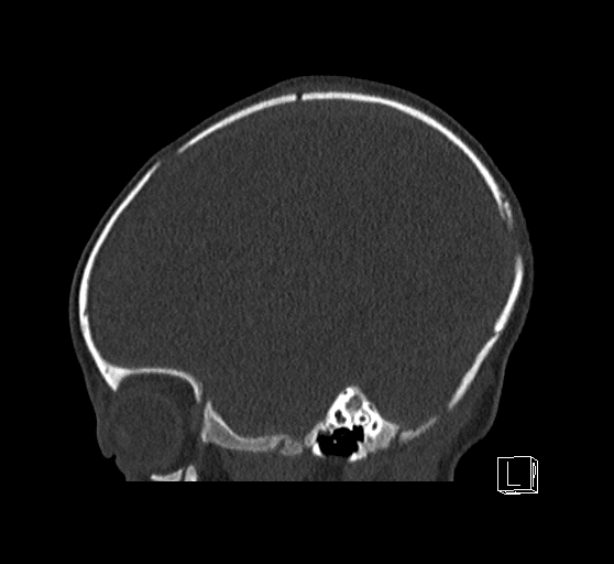 File:Bilateral subdural hemorrhage and parietal skull fracture (Radiopaedia 26058-26192 Sagittal bone window 72).png