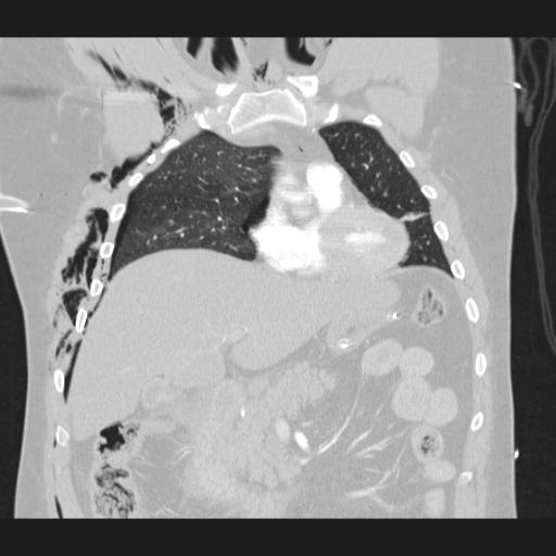 Bilateral traumatic renovascular injury (Radiopaedia 32051-32995 Coronal lung window 28).jpg
