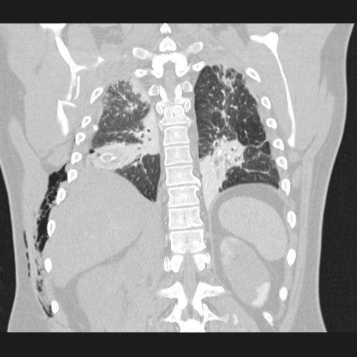 Bilateral traumatic renovascular injury (Radiopaedia 32051-32995 Coronal lung window 60).jpg