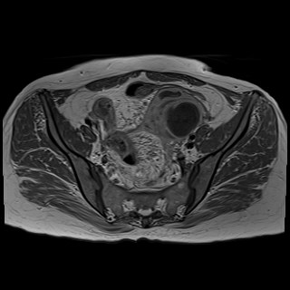 Bilateral tubo-ovarian abscesses (Radiopaedia 58635-65829 Axial T1 C+ 18).jpg