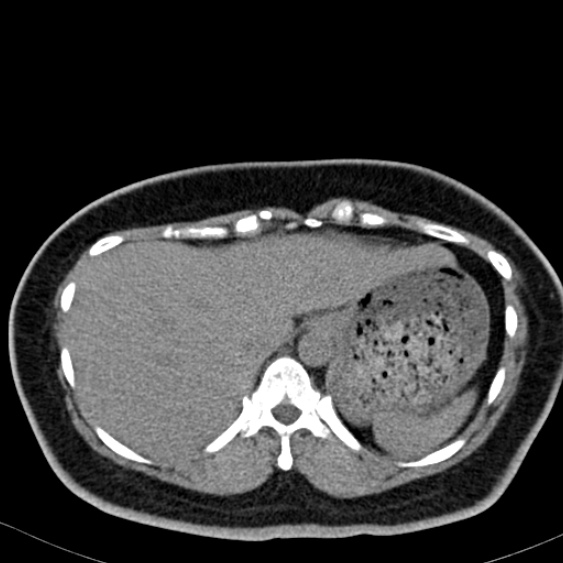 Bilateral ureteric stents (Radiopaedia 48795-53825 Axial non-contrast 5).jpg