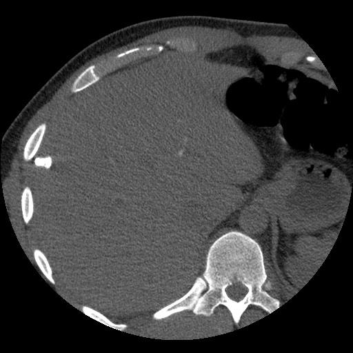 Bile leak from liver traumatic laceration (Radiopaedia 63463-72077 Axial Biliscopin 23).jpg