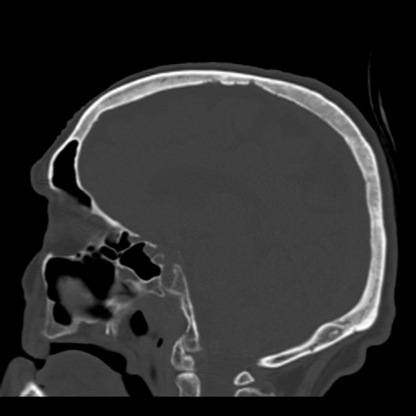Biparietal osteodystrophy (Radiopaedia 46109-50463 Sagittal bone window 48).jpg