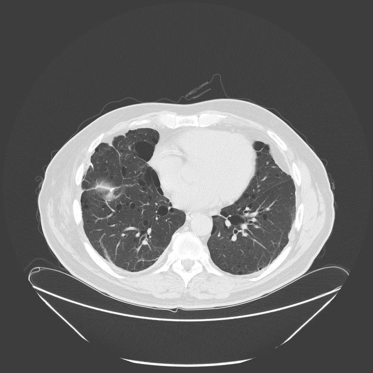 Birt-Hogg-Dubé syndrome (Radiopaedia 52578-58491 Axial lung window 40).jpg