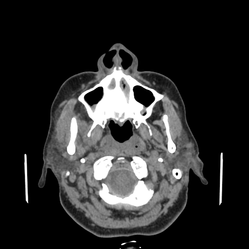 Bisphosphonate-related osteonecrosis of the jaw (Radiopaedia 71324-81642 non-contrast 123).jpg