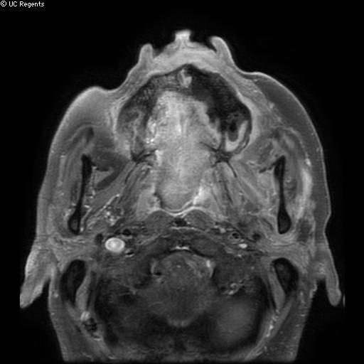 Bisphosphonate-related osteonecrosis of the maxilla (Radiopaedia 51367-57101 Axial T1 C+ fat sat 21).jpg