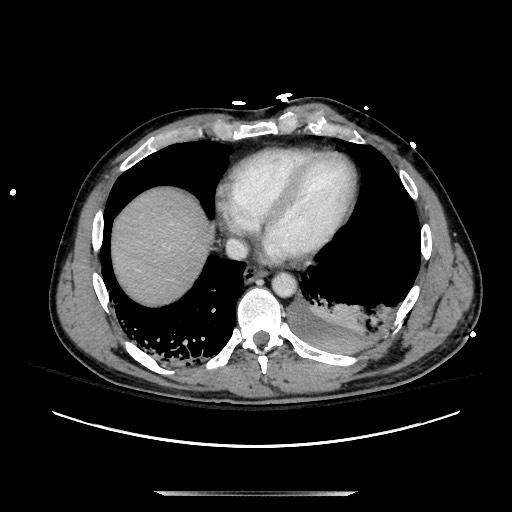 Blunt abdominal trauma with solid organ and musculoskelatal injury with active extravasation (Radiopaedia 68364-77895 A 7).jpg