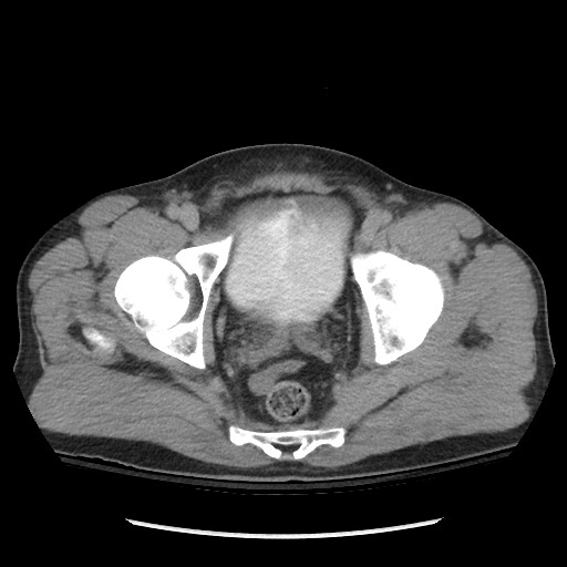 Blunt abdominal trauma with solid organ and musculoskelatal injury with active extravasation (Radiopaedia 68364-77895 Axial C+ delayed 127).jpg