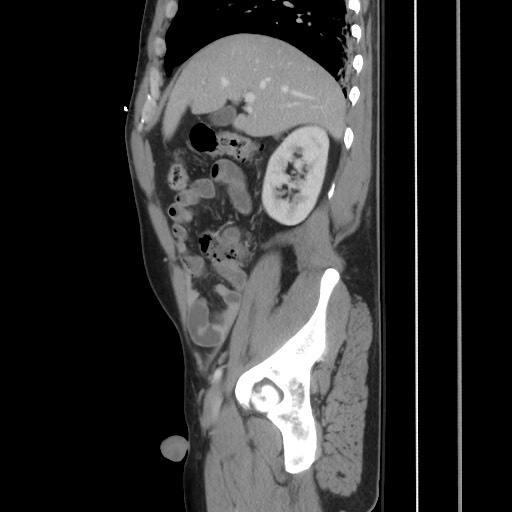 File:Blunt abdominal trauma with solid organ and musculoskelatal injury with active extravasation (Radiopaedia 68364-77895 C 50).jpg
