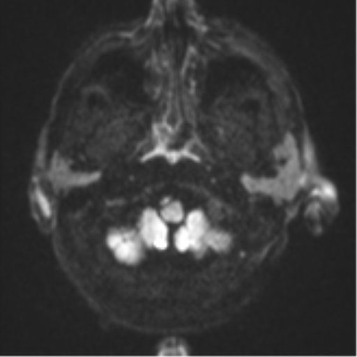 Blunt cerebrovascular injury (Radiopaedia 53682-59745 Axial DWI 34).png