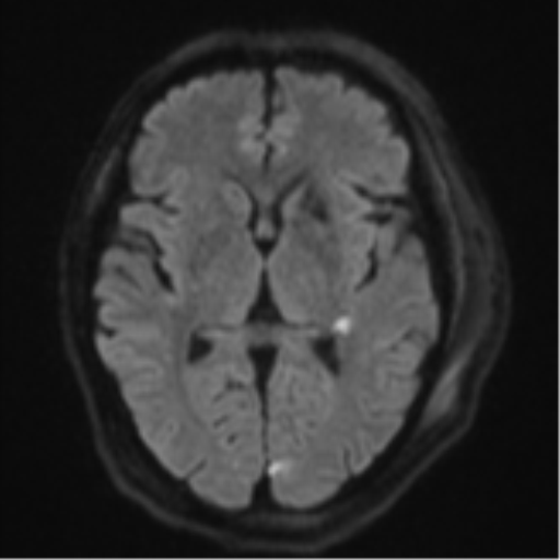 Blunt cerebrovascular injury (Radiopaedia 53682-59745 Axial DWI 46).png
