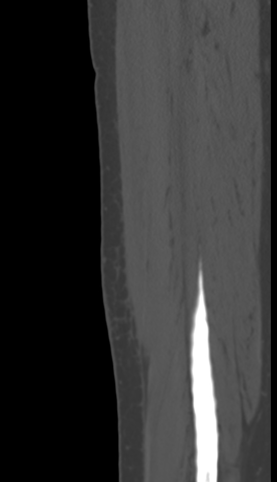 Bone metastasis - tibia (Radiopaedia 57665-64609 Sagittal bone window 144).jpg