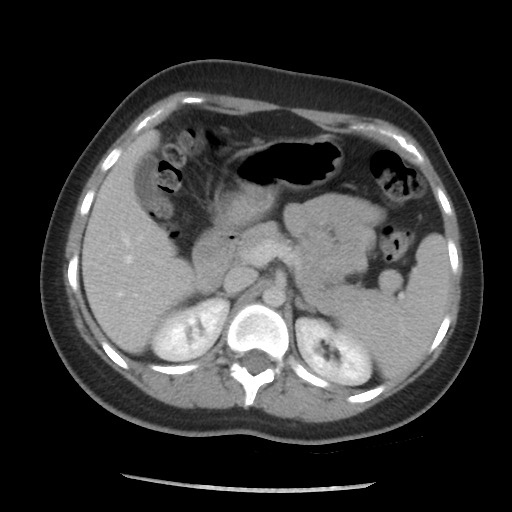 File:Borderline mucinous tumor (ovary) (Radiopaedia 78228-90808 A 77).jpg