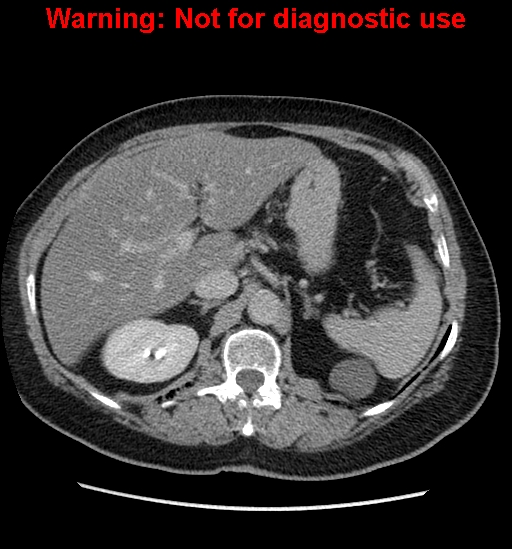 File:Bosniak renal cyst - type II (Radiopaedia 23404-23468 F 16).jpg