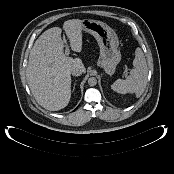 Bosniak renal cyst - type IV (Radiopaedia 24244-24518 Axial non-contrast 99).jpg