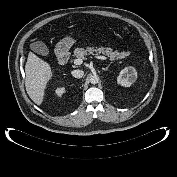 Bosniak renal cyst - type IV (Radiopaedia 24244-24518 C 107).jpg