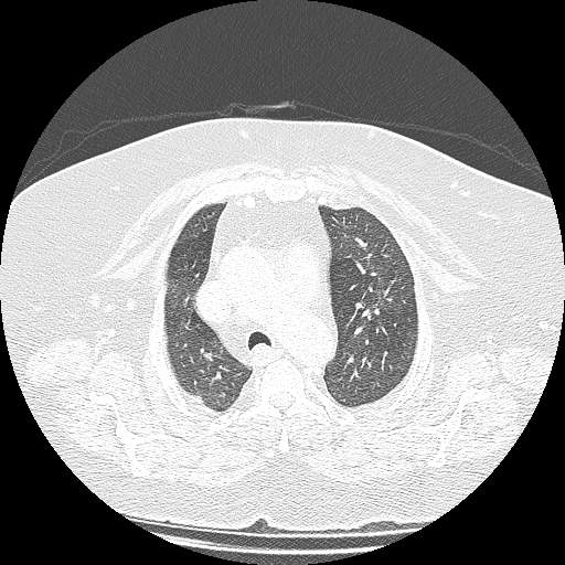 Bovine aortic arch - right internal mammary vein drains into the superior vena cava (Radiopaedia 63296-71875 Axial lung window 41).jpg