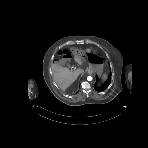 File:Bowel ischemia secondary to SMA occlusion with extensive portomesenteric venous gas (Radiopaedia 54656-60871 A 64).jpg