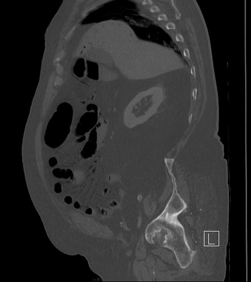 Bowel ischemia secondary to SMA occlusion with extensive portomesenteric venous gas (Radiopaedia 54656-60871 Sagittal bone window 80).jpg