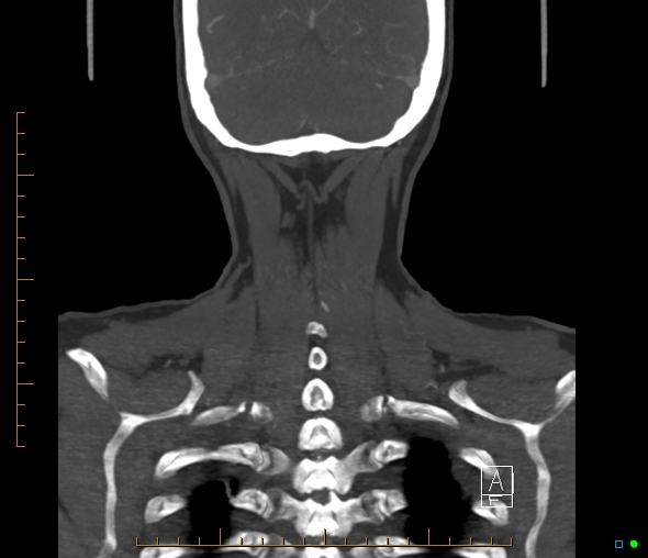 Brachiocephalic trunk stenosis (Radiopaedia 87242-103519 B 62).jpg