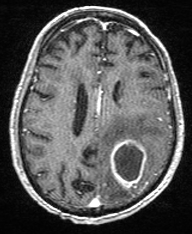Brain abscess with dual rim sign (Radiopaedia 87566-103938 Axial T1 C+ 109).jpg
