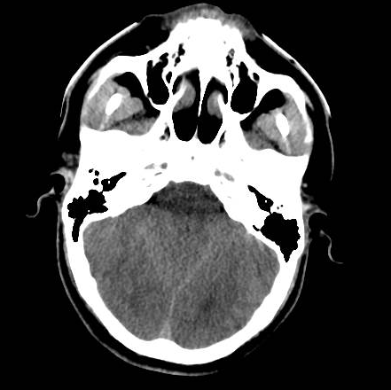 File:Brain death after motor vehicle collision (Radiopaedia 88470-105114 Axial 13).png