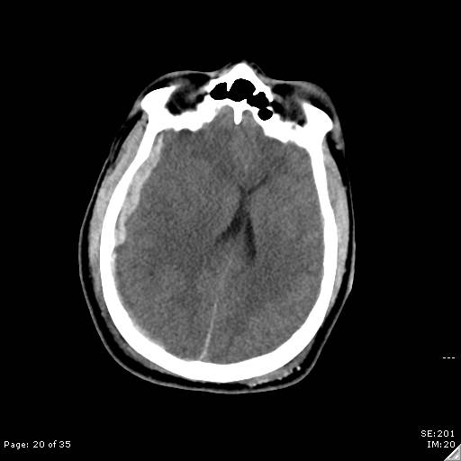 File:Brain death after motor vehicle collision (Radiopaedia 88470-105114 Axial non-contrast 20).jpg